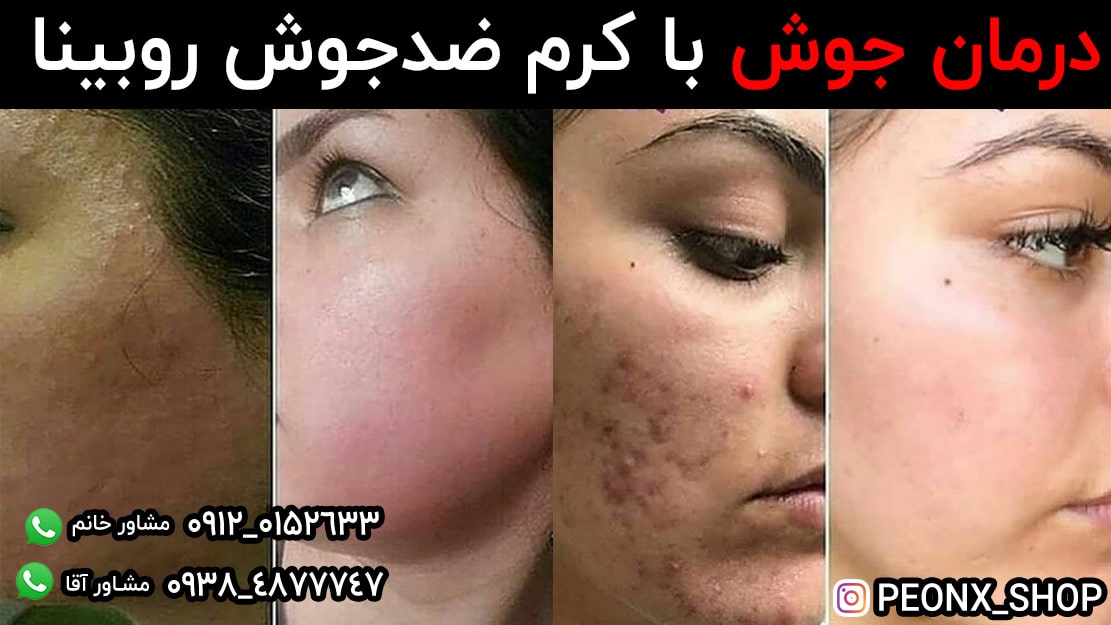کرم ضدجوش قوی روبینا سیلور