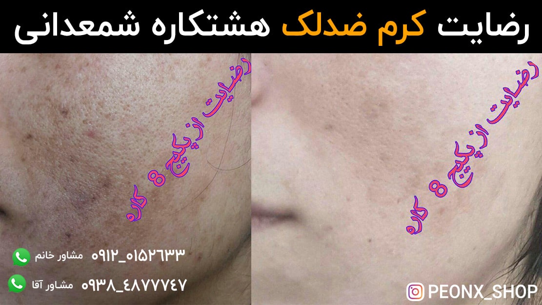 رضایت مشتری از مصرف کرم ضدلک هشتکاره شمعدانی